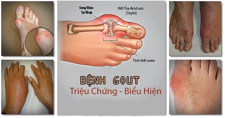 Bệnh gout nên ăn gì và kiêng gì? Thực đơn tốt cho người bị gout