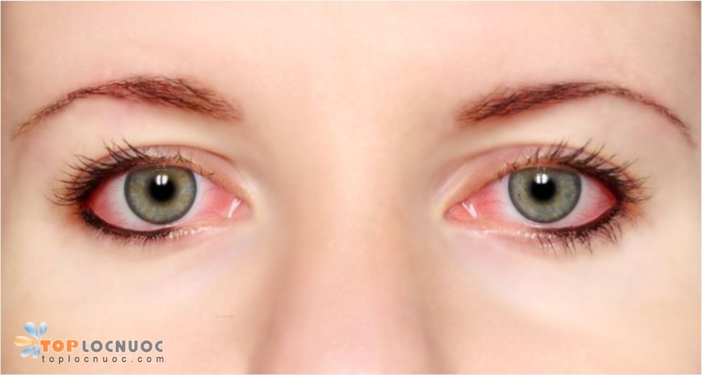 Nước tinh khiết có tác dụng giữ cho đôi mắt khỏe mạnh?