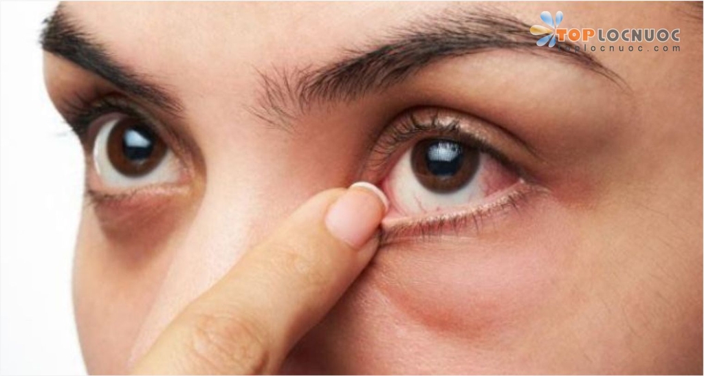 Nước tinh khiết có tác dụng giữ cho đôi mắt khỏe mạnh?