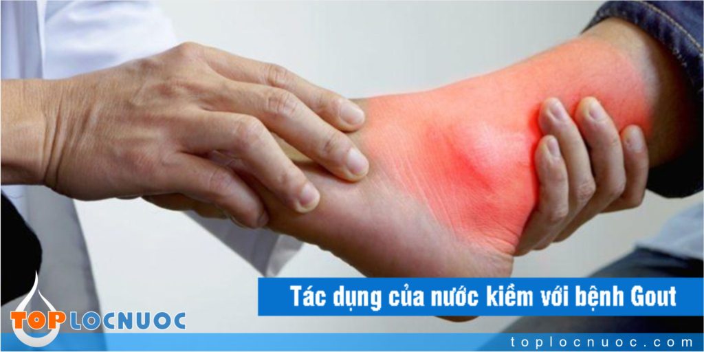 Bệnh nhân bị gout uống nước ion Kiềm có tác dụng gì?