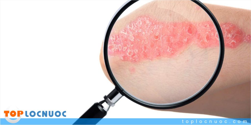 Điều trị bệnh vảy nến bằng nước ion Kiềm có hiệu quả không?