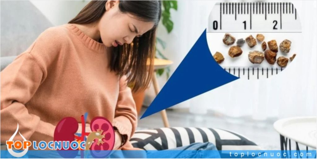 Nước khoáng, nước suối có ảnh hưởng gì tới người bị sỏi thận?