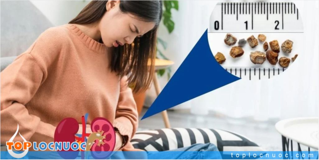 Nước khoáng, nước suối có ảnh hưởng gì tới người bị sỏi thận?