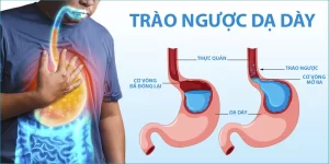 Nước ion Kiềm giúp hỗ trợ điều trị ung thư dạ dày: Có đúng không?