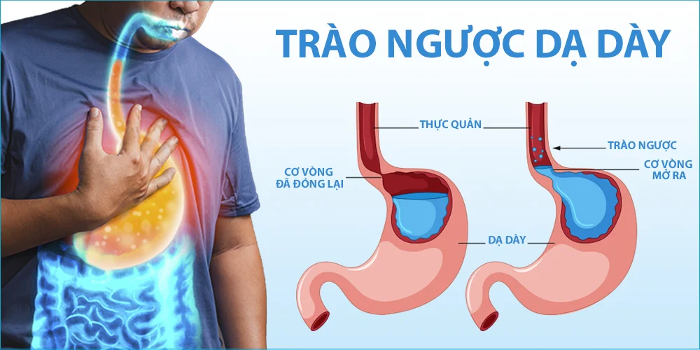Nước ion Kiềm giúp hỗ trợ điều trị ung thư dạ dày: Có đúng không?