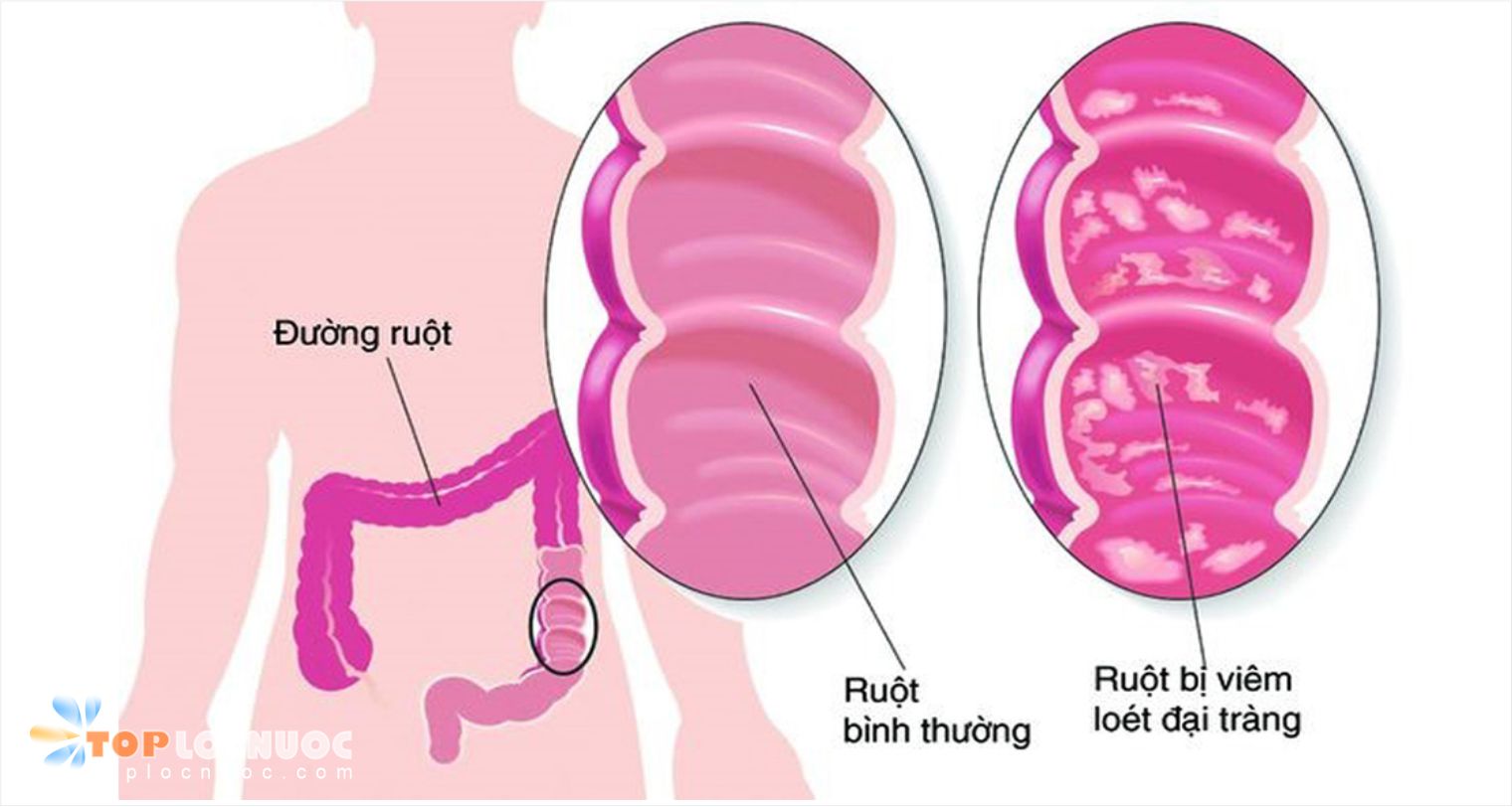 Bào tử lợi khuẩn Probiotic là gì