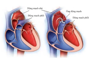 Bệnh tim tồn tại lỗ bầu dục là gì? Phương pháp chẩn đoán và điều trị