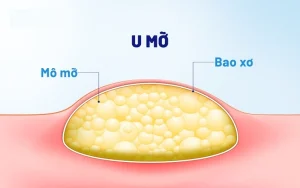 Lipoma U mỡ là gì? Lành tính hay ác tính? Có nguy hiểm không?