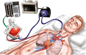 Máy ECMO là gì? Chức năng và công dụng của máy ECMO trong y học