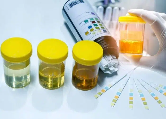 Sáng ngủ dậy thấy nước tiểu vàng như nước chè có làm sao không?