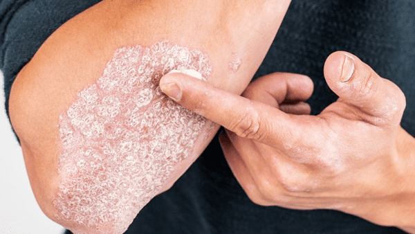 Nước điện giải ion Kiềm hỗ trợ điều trị bệnh vảy nến