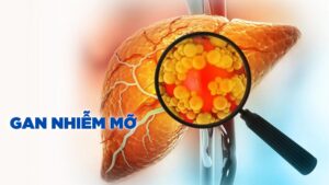 Bệnh gan nhiễm mỡ là gì và 4 cách phòng tránh hiệu quả nhất
