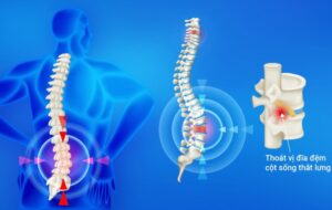 Bệnh thoát vị đĩa đệm là gì? Có mức độ nguy hiểm như thế nào?