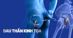 Đau thần kinh tọa là gì? Đau thần kinh tọa có nguy hiểm không?
